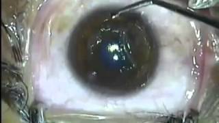 LASIK laser eye Surgery video EPI LASIK [upl. by Airotkciv]