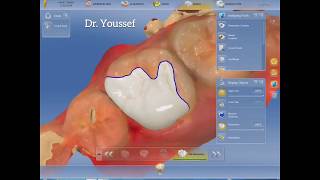 Onlay indirect restoration  cerec CadCam [upl. by Htinnek208]