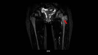 CAR  Case of the week  Case 12  Tubercular osteomyelitis [upl. by Nnayllek]