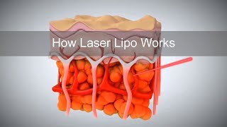 How Laser Lipo Works to Release Fat and Reduce Cellulite [upl. by Tzong]