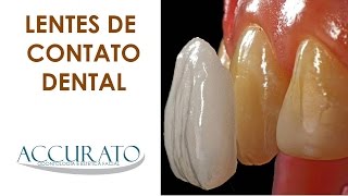 QUANTO CUSTA LENTES DE CONTATO DENTAL DE RESINA São mais baratas VOU FALAR O PREÇO [upl. by Aicilf]