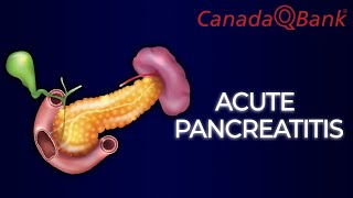 Acute Pancreatitis [upl. by Eseret]