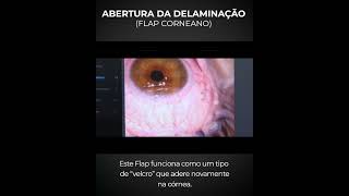 Como é feita a Cirurgia Refrativa a Laser para a correção da Miopia Hipermetropia e Astigmatismo [upl. by Atsedom]