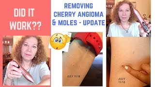 UPDATE VIDEO Did It Work  Burning off Cherry Angioma Skin Tags  REAL EXPECTATIONS [upl. by Enelyak161]