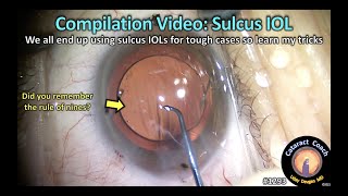 CataractCoach 1293 compilation video sulcus IOL tricks and surgical pearls [upl. by Nerin]