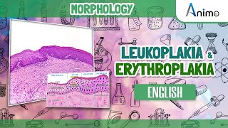 Leukoplakia and Erythroplakia  GIT Morphology  English [upl. by Murage]