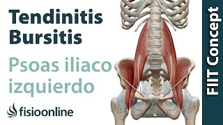 Tendinitis y bursitis del psoas ilíaco izq  Visión desde la fisioterapia y la medicina natural [upl. by Wiener]