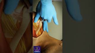 Coracoid Process  Shoulder injection Technique  shorts education [upl. by Batruk]