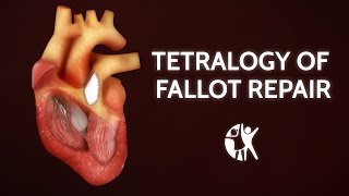 Tetralogy of Fallot Repair  Cincinnati Childrens [upl. by Saitam]