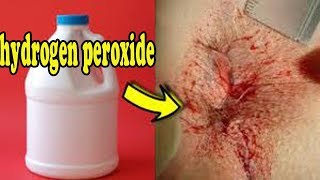 Use hydrogen peroxide for hemorrhoids treatment without surgery  Activebeat [upl. by Atileda]