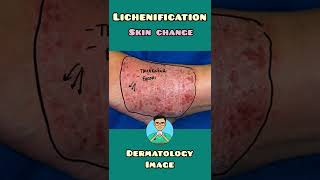 Lichenification  Dermatology  shorts [upl. by Betty209]