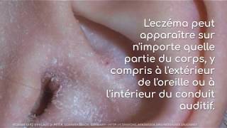 eczema de loreille partie I [upl. by Allcot]