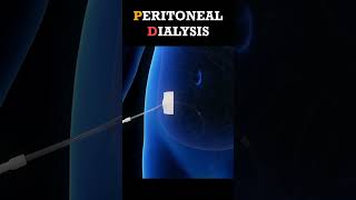 Peritoneal Dialysis Procedure shorts dialysis [upl. by Mal929]