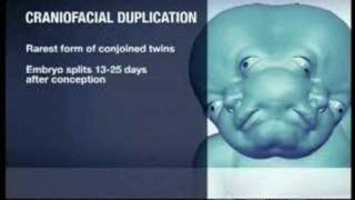 Two Faced Baby  Lali Was Born With Craniofacial Duplication [upl. by Ailin]