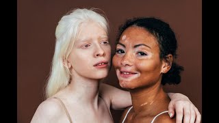 Albinism Symptoms and Causes  Diagnosis  Treatment  Prevention [upl. by Philippe]