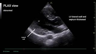 PoCUS Echo  Hypertrophic Cardiomyopathy HCM [upl. by Allemaj]