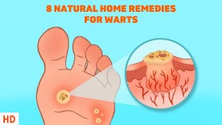 8 Surprising Home Remedies for Warts  Get Rid of Them Naturally [upl. by Asiulairam]