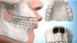 Extractions de dents pour correction surplomb horizontal [upl. by Notsnarc]