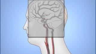 Diagnostic Cerebral Angiography [upl. by Nnylyt261]