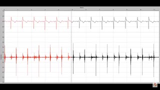 Systolic murmur in mitral regurgitation [upl. by Ihpen]