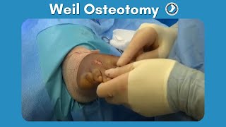 Weil Osteotomy Performed by Dr Paul Steinke [upl. by Queena461]