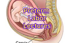 Preterm Labor Lectures part 5  Tx of preterm labor gynaecologists obstrectic tenteachers obs [upl. by Lareine]