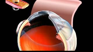 OsteoOdontoKeratoprosthesis Procedure Artwork by Stephen F Gordon [upl. by Fabri752]