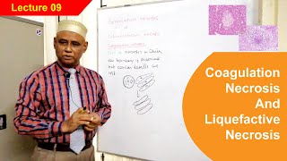 General Pathology Lecture 9  Coagulation Necrosis amp Liquefactive Necrosis [upl. by Ahsiened]