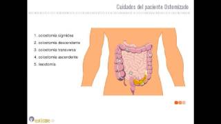 Cuidados del paciente ostomizado [upl. by Ponzo]