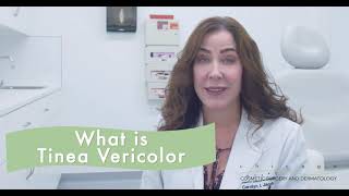 Tinea Versicolor How to Treat [upl. by Esirahs697]