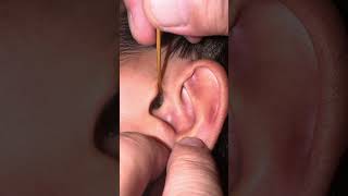 【閲覧注意】《耳掃除》反対の耳からもでっけぇ耳垢はがしてみた asmr ear 耳かき 耳垢 ピンセット 耳掃除 clean earwax wax 귀이개 [upl. by Dnomso394]