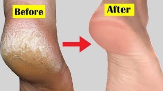 Dead skin removal and Cracked heels treatment Callus removal from feet ep60 Cao​Clinic [upl. by Ahseuqal]