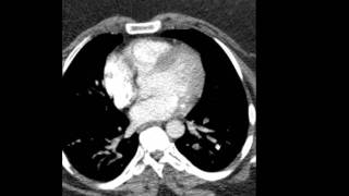 Pulmonary Embolism CT Discussed by Radiologist [upl. by Esile]