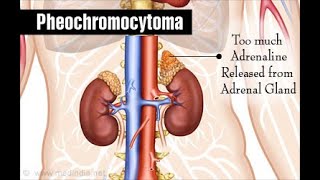 Pheochromocytoma Symptoms Pathophysiology Diagnosis and Treatment [upl. by Ntsyrk756]