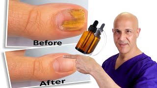 1 Oil Cures Toe Nail Fungus  Dr Mandell [upl. by Key]