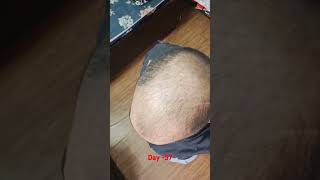 Hair transplant day 57  hairtransplantation prphairtreatment hair shorts [upl. by Haidabej]