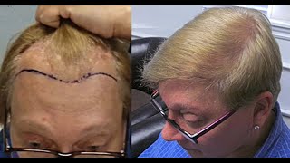 Transgender Hair Transplant Client Testimonial Hair Restoration Specialists of Atlanta [upl. by Bergen146]