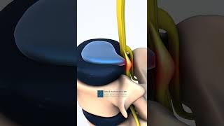 Lumbar Spine Herniated Disc Medical Animation [upl. by Ahsial]