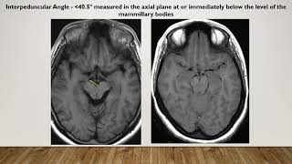 CAR  Case of the week  Case 5  Secondary intracranial hypotension [upl. by Amador]