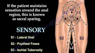 Sacral Sparing  Everything You Need To Know  Dr Nabil Ebraheim [upl. by Mead158]