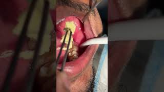 Dentigerous Cyst Surgical outcome l 07044611705 l Dr Arindam Mandal OMFS [upl. by Ailuj]