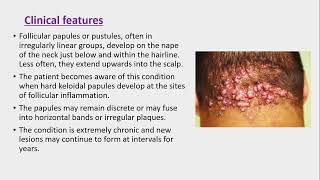 Lecture200 Acquired disorders of Pilosebaceous units Rooks chapter 93 [upl. by Karry]