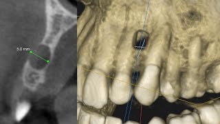 An Asymptomatic Odontogenic ToothRelated Cyst Surgical and Endodontic Management [upl. by Erlandson368]