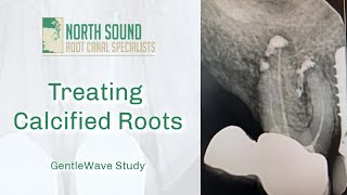 Root Canal Treatment on a Calcified Tooth GentleWave® [upl. by Neddie]