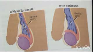 ReproductionDiseases of the Testes [upl. by Jonny]