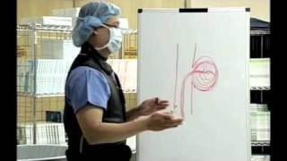 Tom L Yao MD explains the procedure of coiling an aneurysm [upl. by Leahcym]