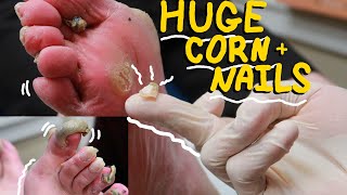 MASSIVE CORN AND NAILS SUPER Satisfying Corn removal and nails [upl. by Ocirderf89]