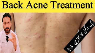 Treatment of Back Acne Shoulder Acne and Chest Acne in Urdu  Get Rid Of Back Acne  Dr Nadeem Rph [upl. by Grosberg802]