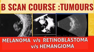 Bscan course  Differentiating choroidal melanoma from retinoblastoma and choroidal hemangioma [upl. by Eiramesor49]