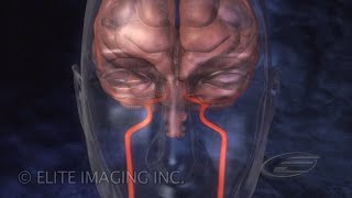 Brain Clot Removal  Medical amp Scientific Video Production [upl. by Proudlove821]